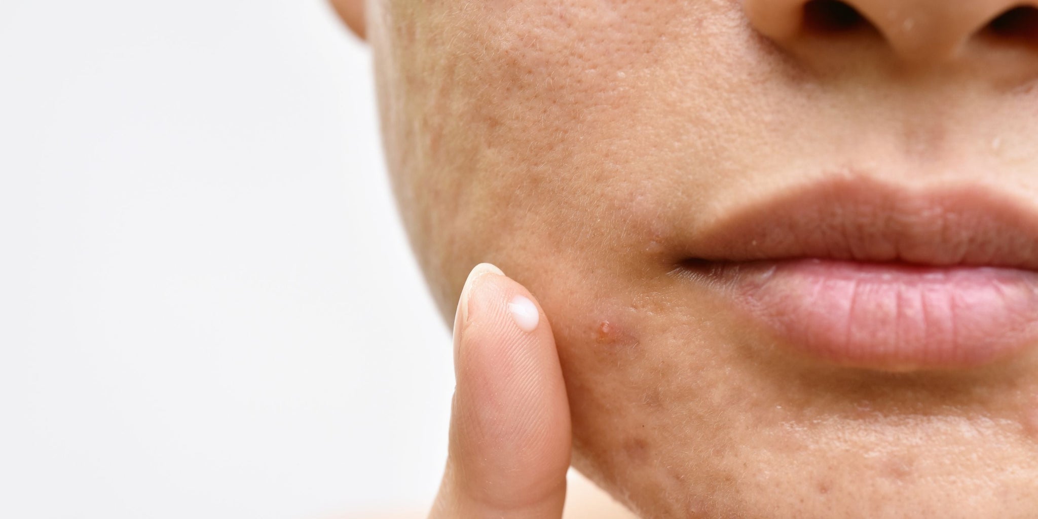 What skincare can you use when on isotretinoin?