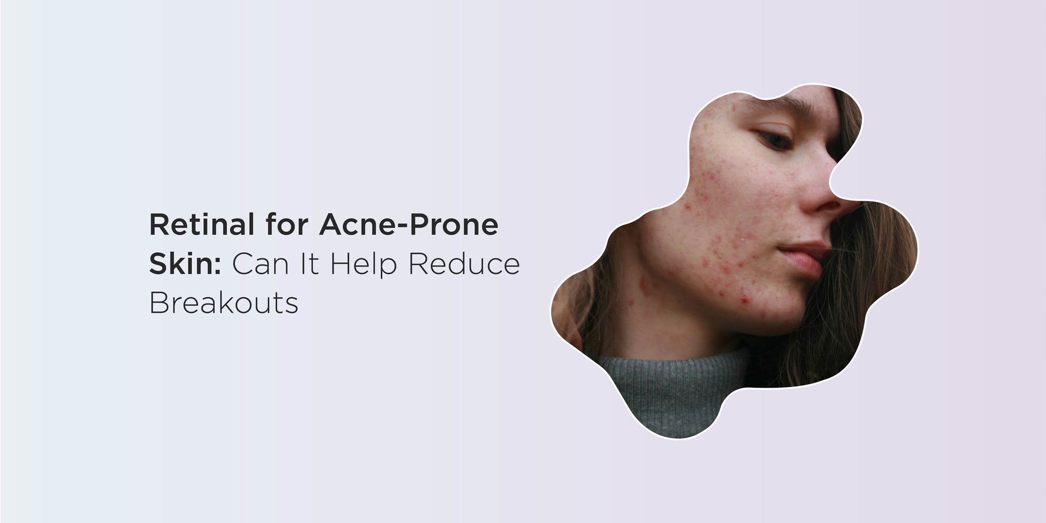 Retinal for Acne-Prone Skin: Can It Help Reduce Breakouts