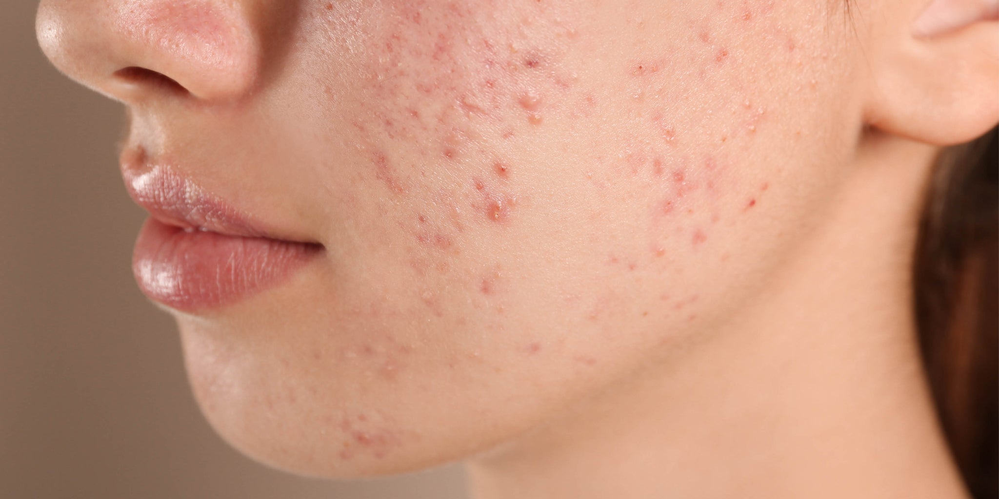 My teen is picking their pimples – is that ever ok?