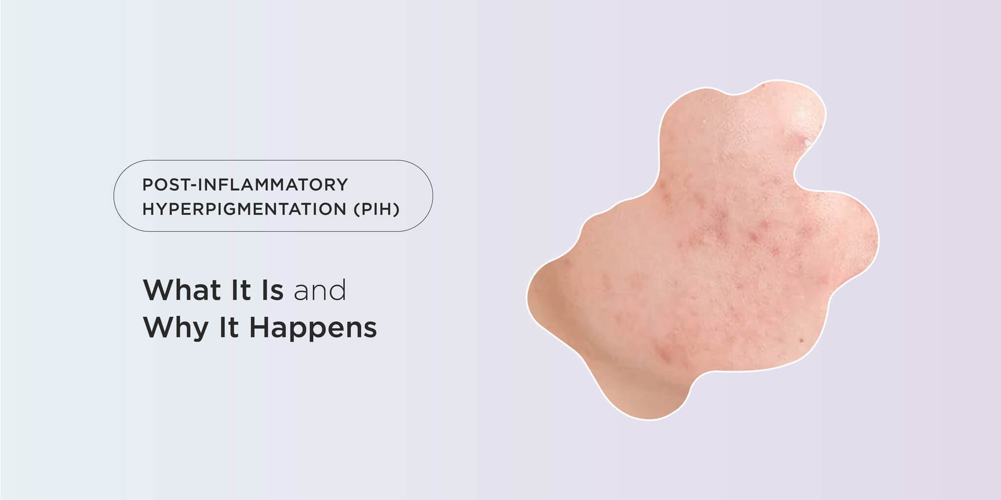 Post-Inflammatory Hyperpigmentation (PIH): What It Is and Why It Happens