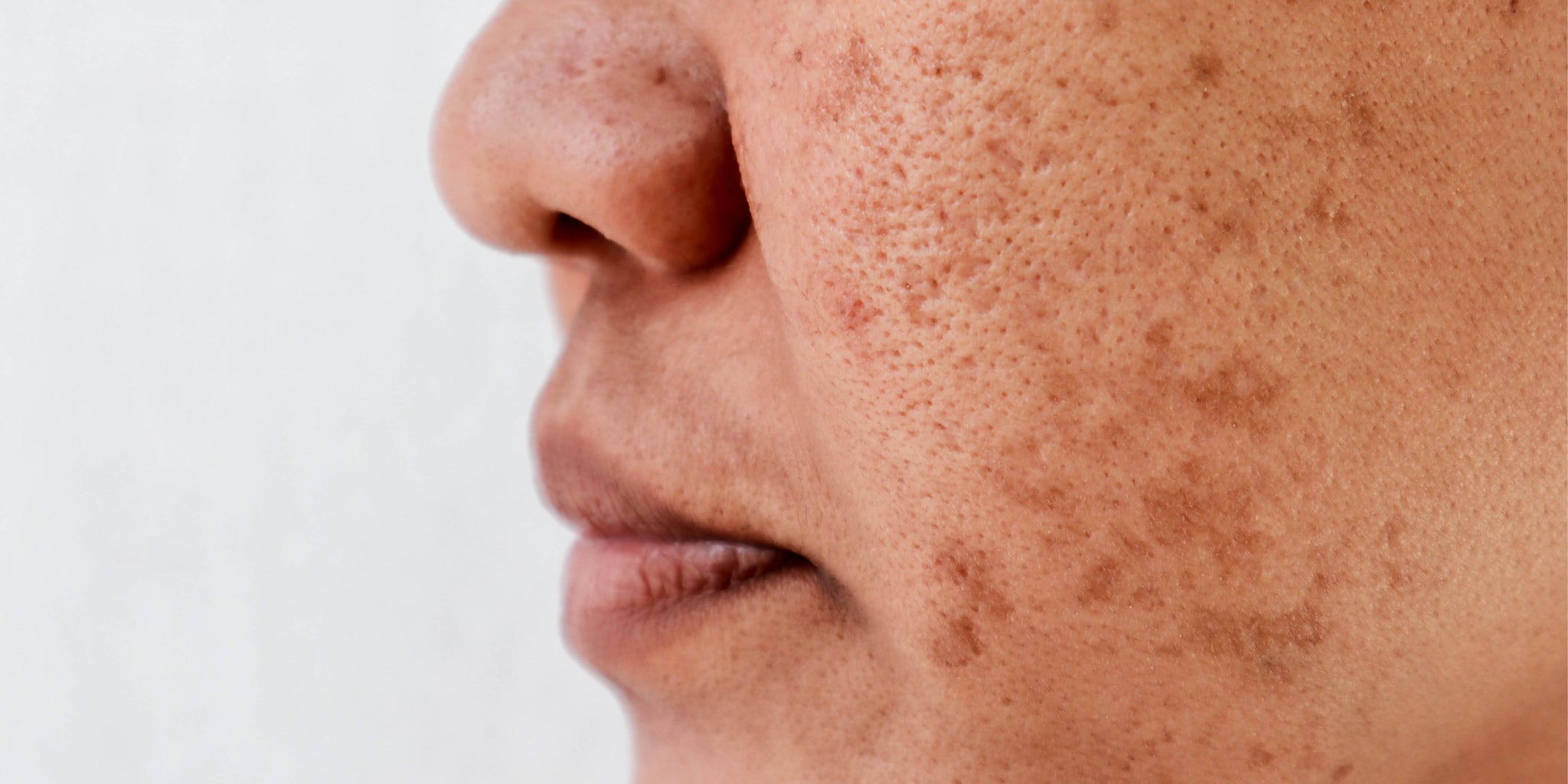 Why targeting pigmentation from one angle is not enough: what the research shows