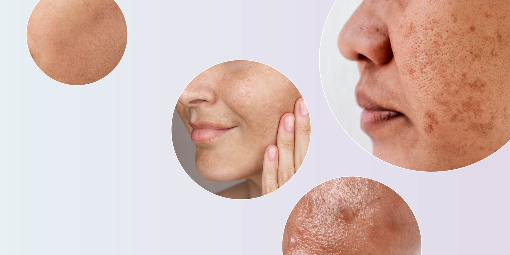 4-N-Butylresorcinol: the evidence-based alternative to hydroquinone for pigmentation