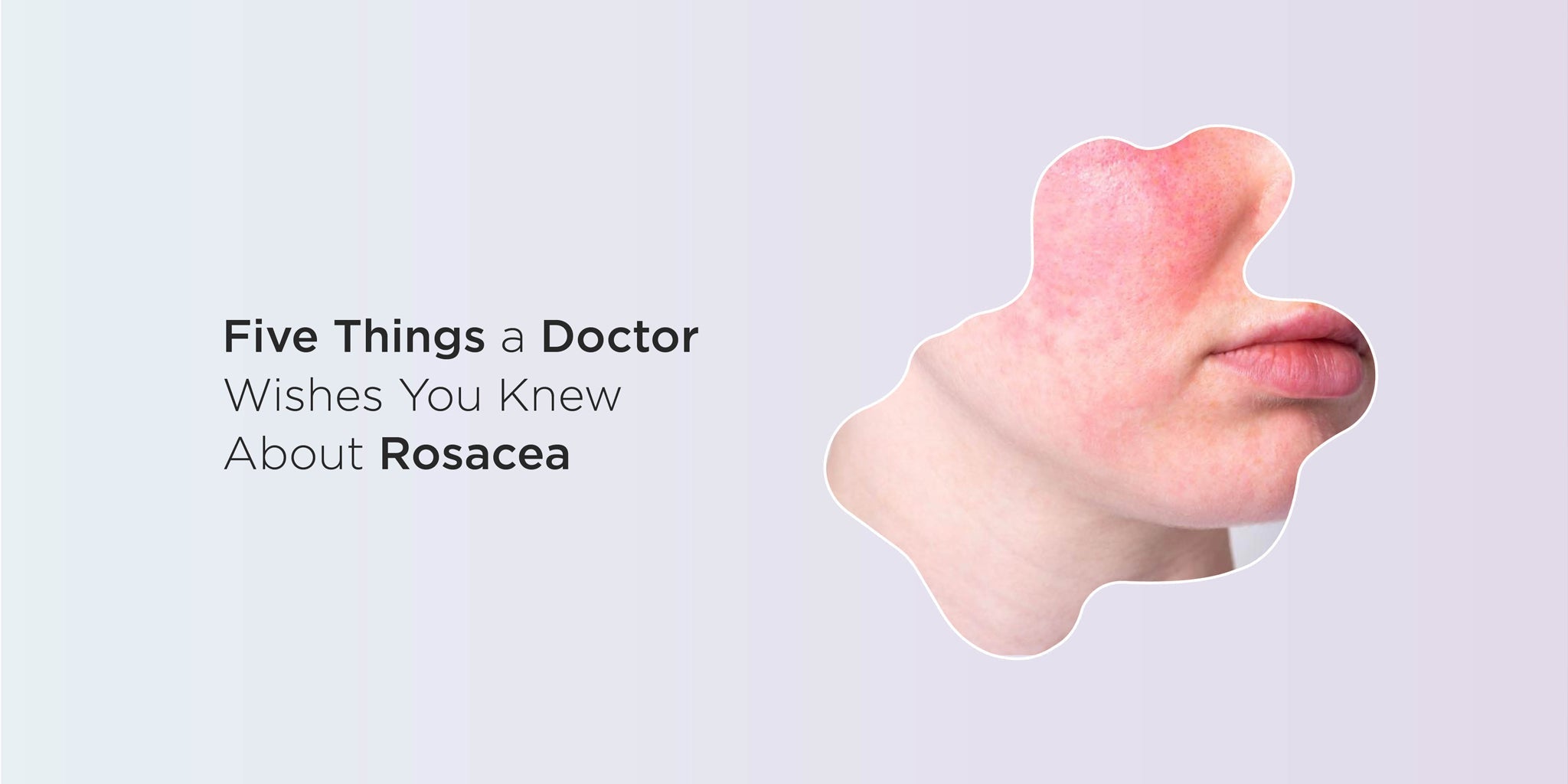 5 Things a Doctor Wishes You Knew About Rosacea