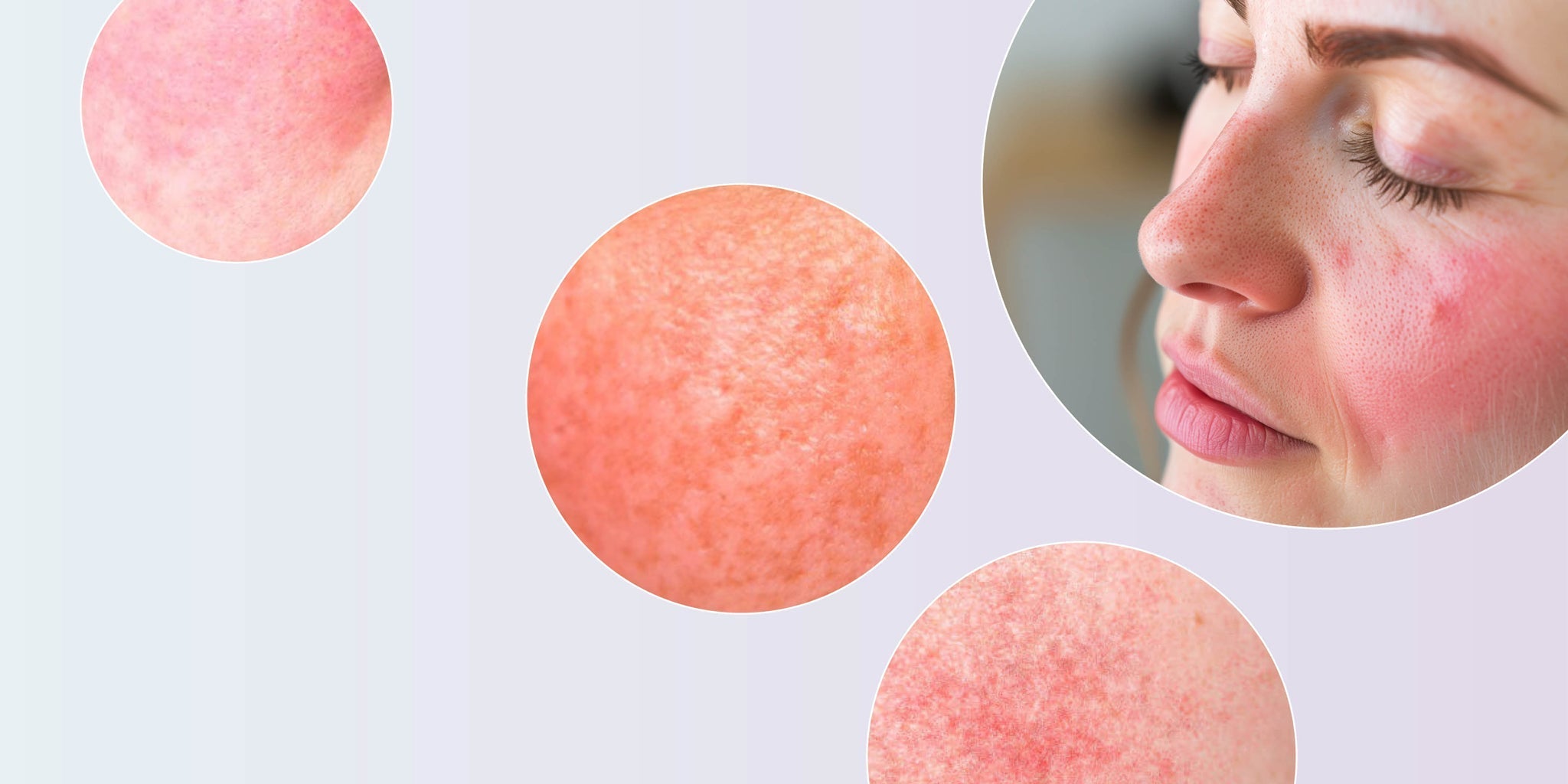 How to Spot Rosacea