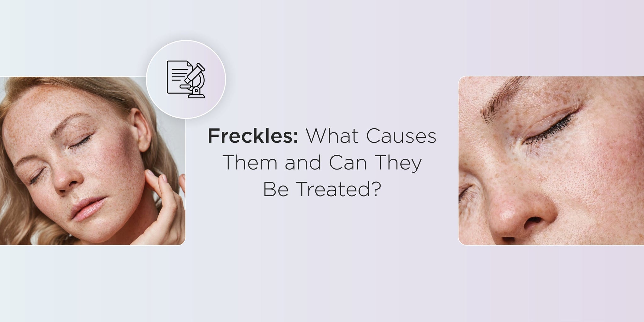 Freckles: What Causes Them and Can They Be Treated?