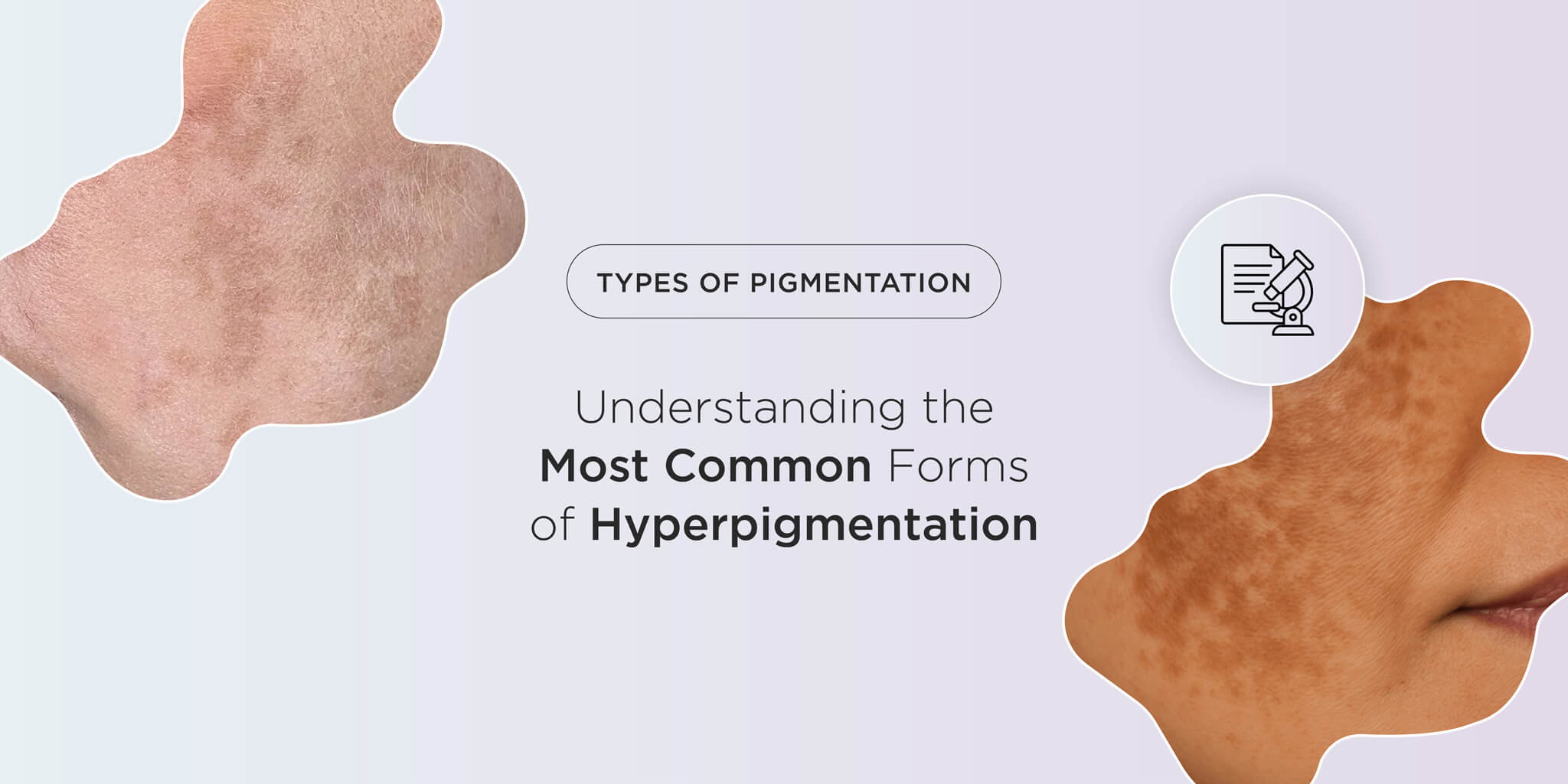 Types of Pigmentation: Understanding the Most Common Forms of Hyperpigmentation
