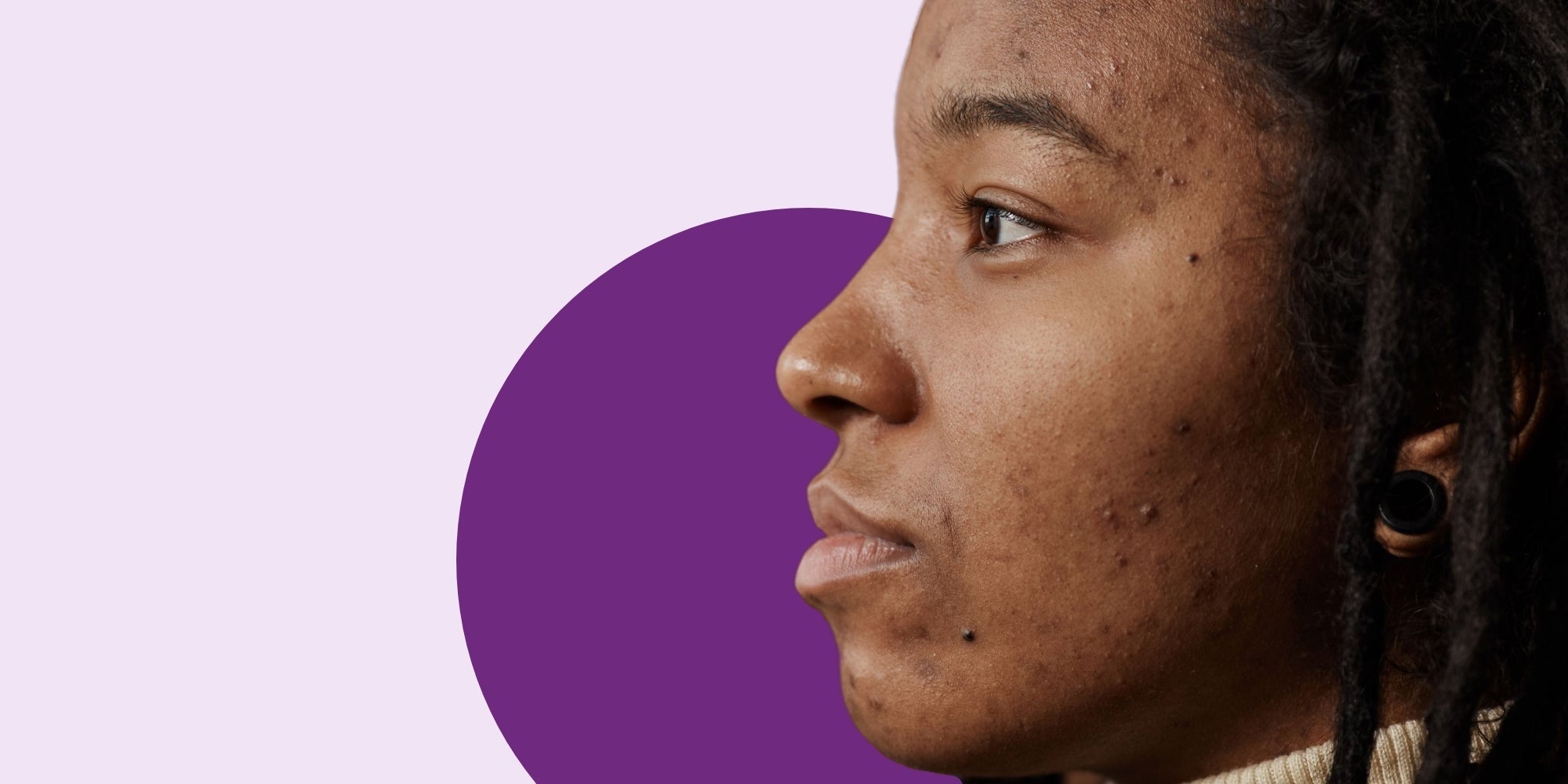 How to tackle hormonal acne