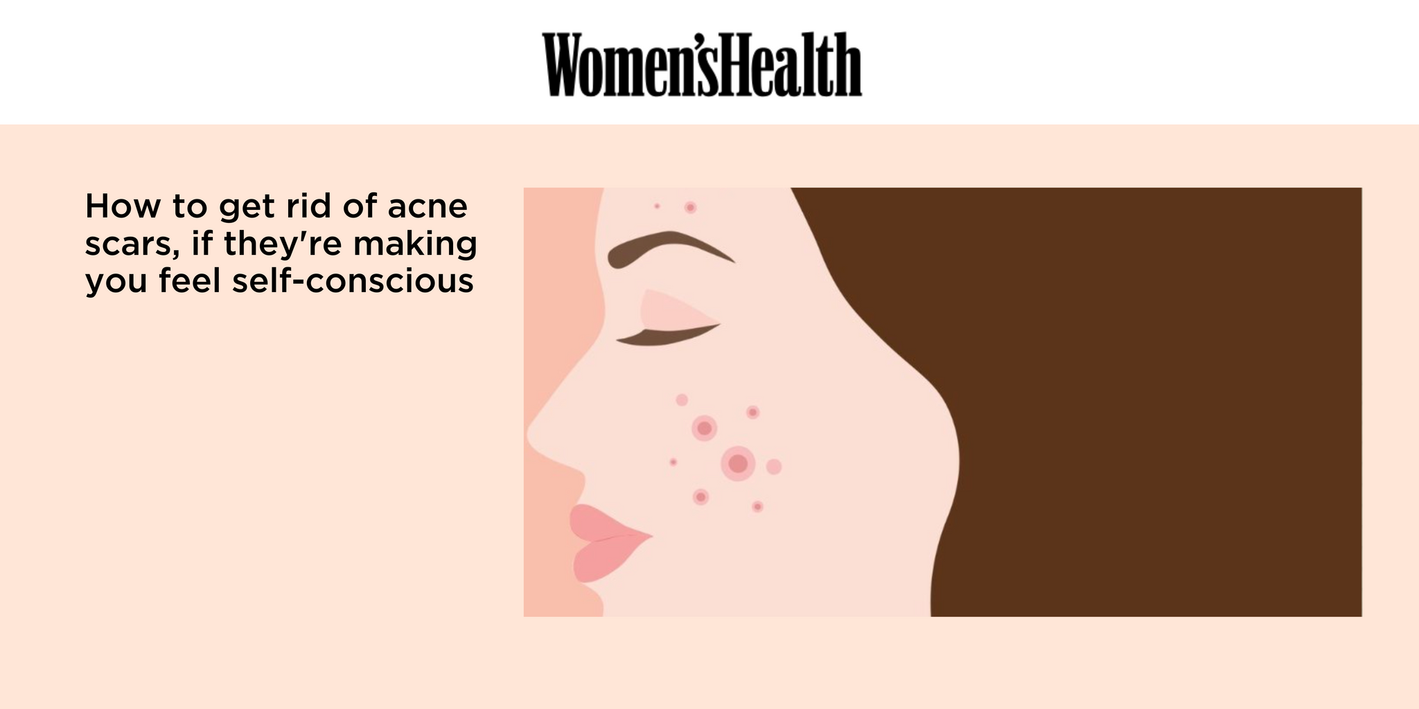 How to get rid of acne scars, if they're making you feel self-conscious