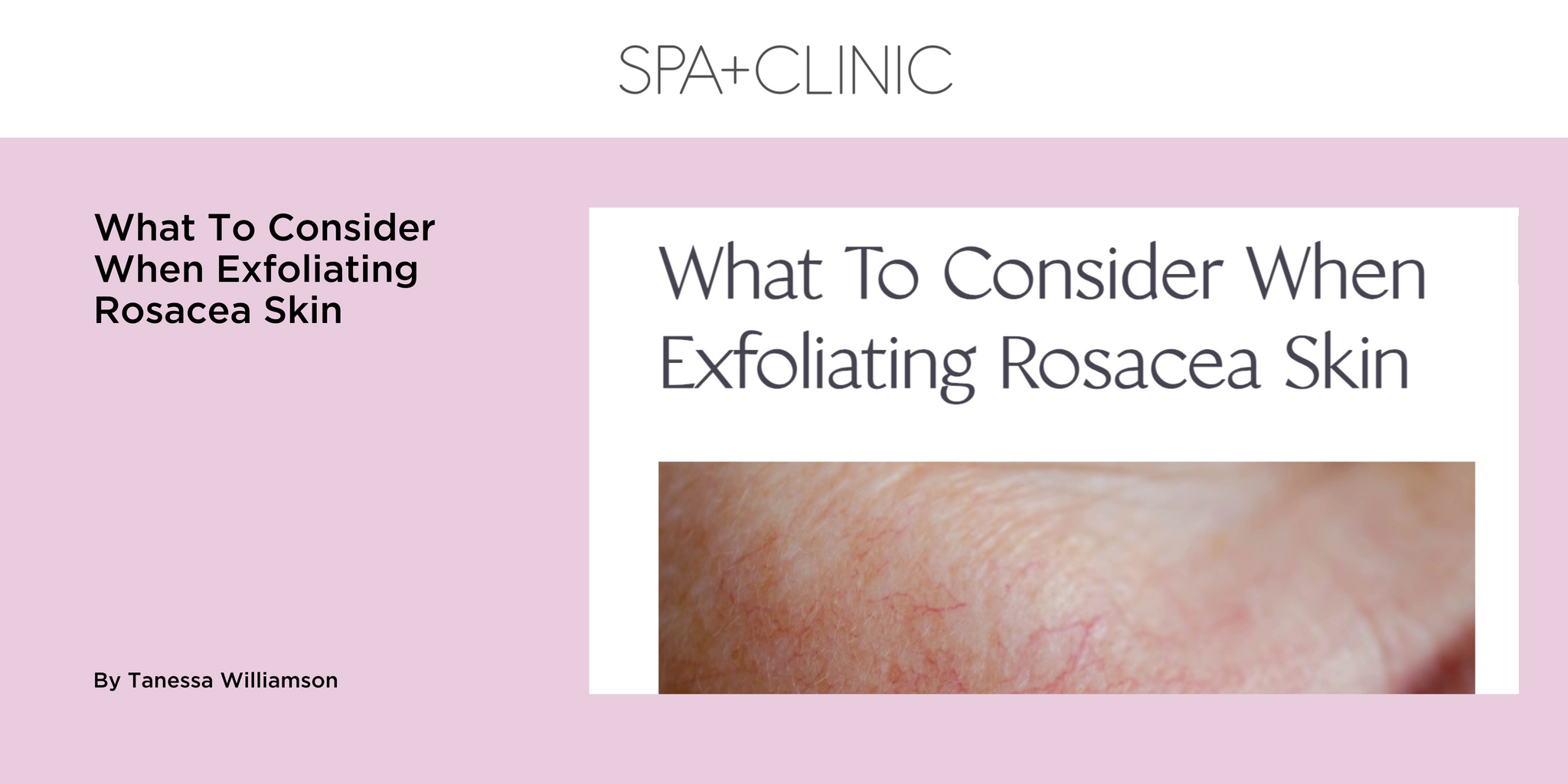 What To Consider When Exfoliating Rosacea Skin