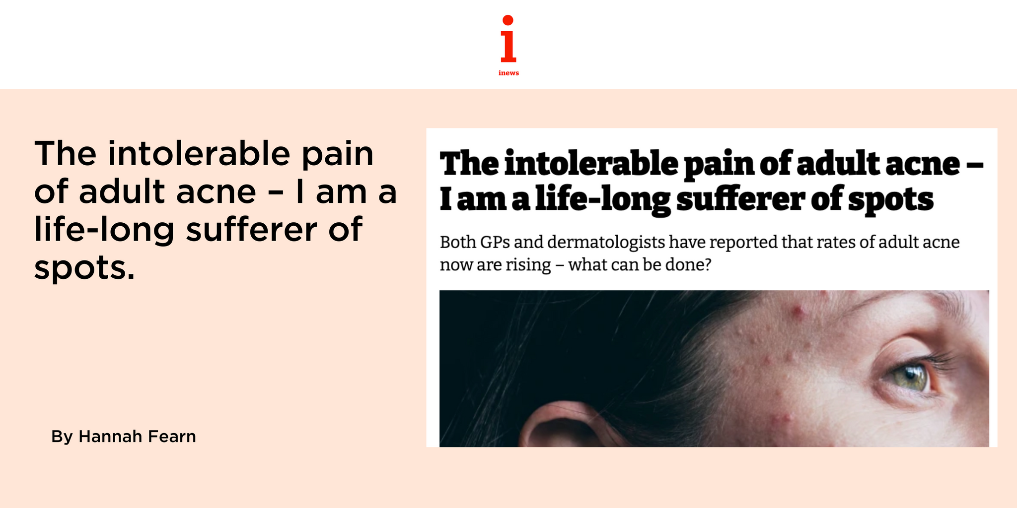 The intolerable pain of adult acne – I am a life-long sufferer of spots