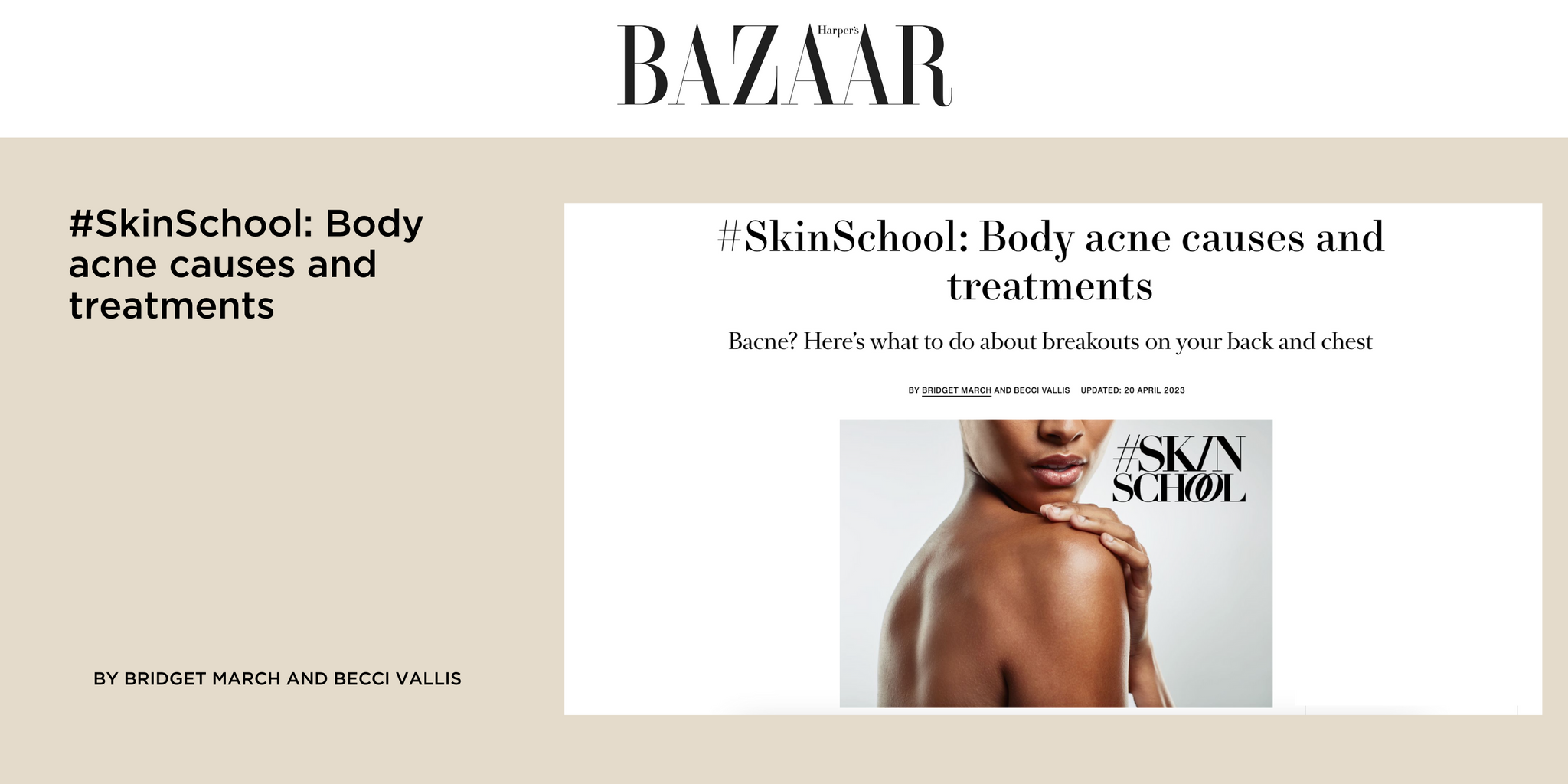 #SkinSchool: Body acne causes and treatments