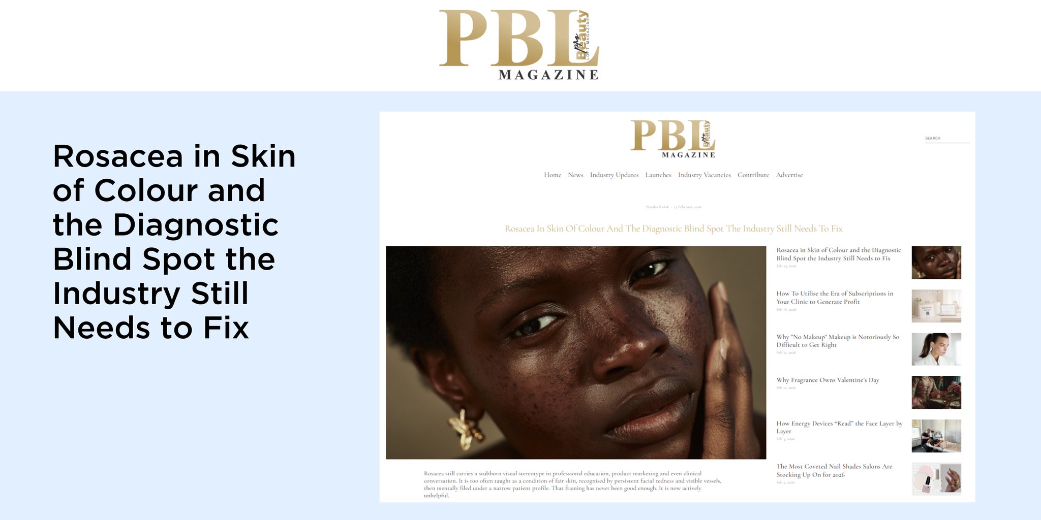 Rosacea in Skin of Colour and the Diagnostic Blind Spot the Industry Still Needs to Fix