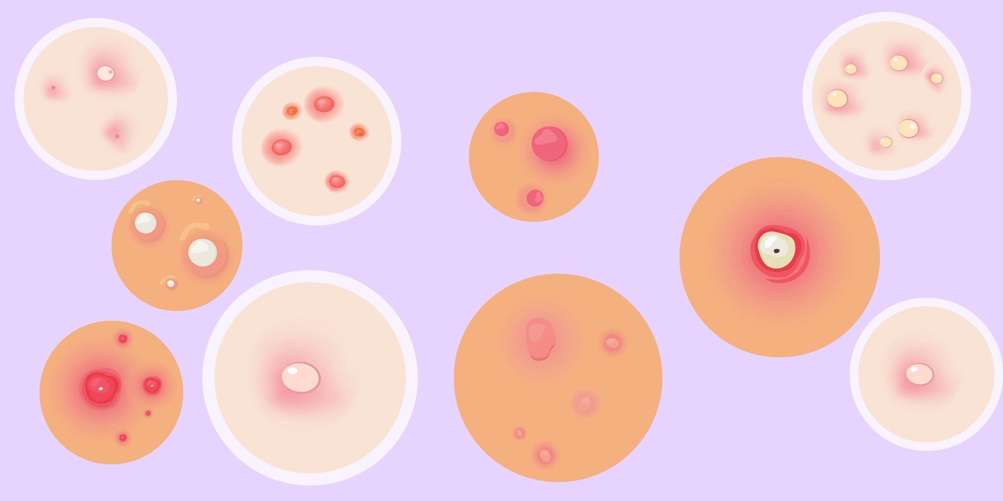 Your ultimate guide to that PIMPLE