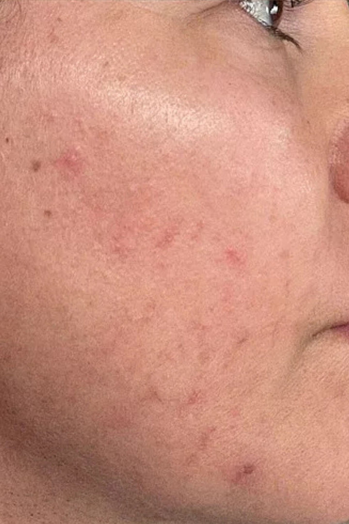 4-N-Butylresorcinol Skincare for Dark Spots