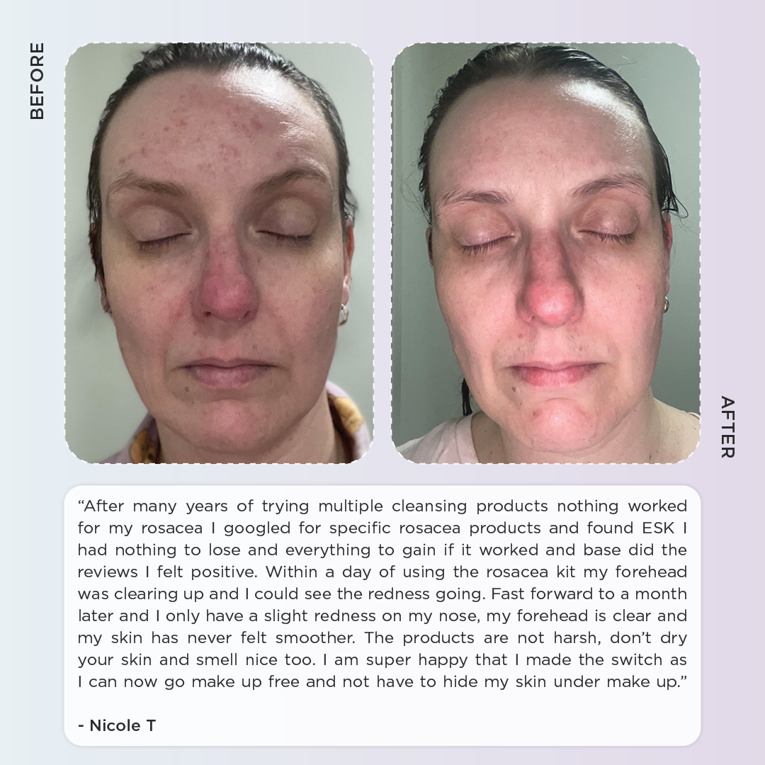 Rosacea Skincare Kit - Anti Redness