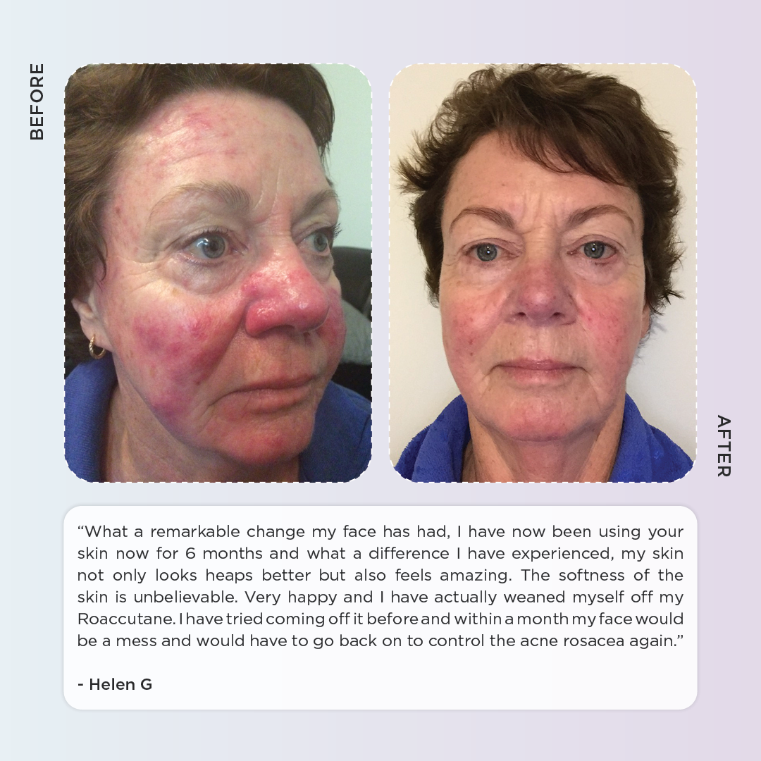 Rosacea Skincare Kit - Anti Redness