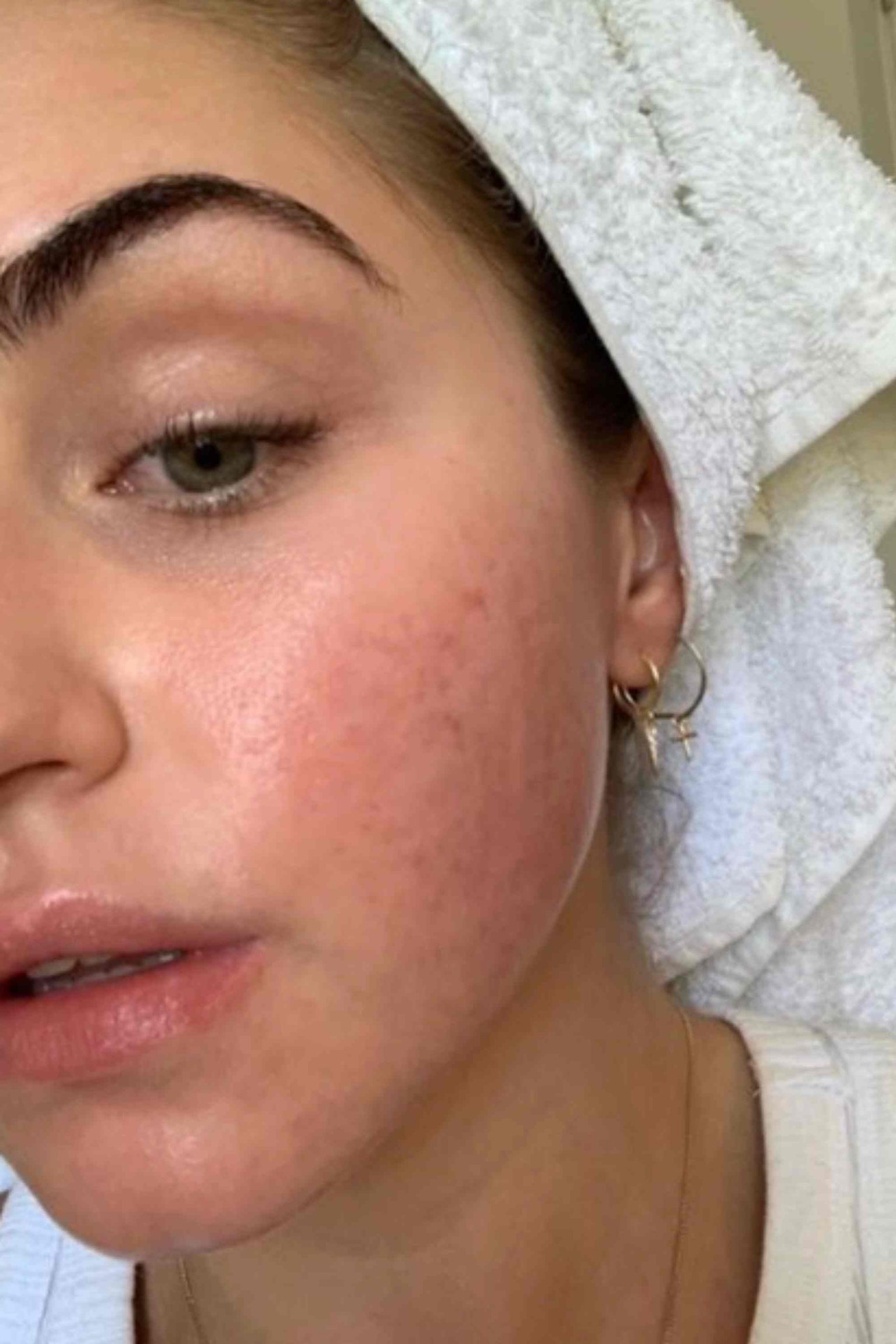 Acne Skincare Products | Buy Acne Products Online - ESK
