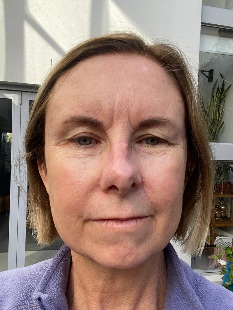 Before Rosacea