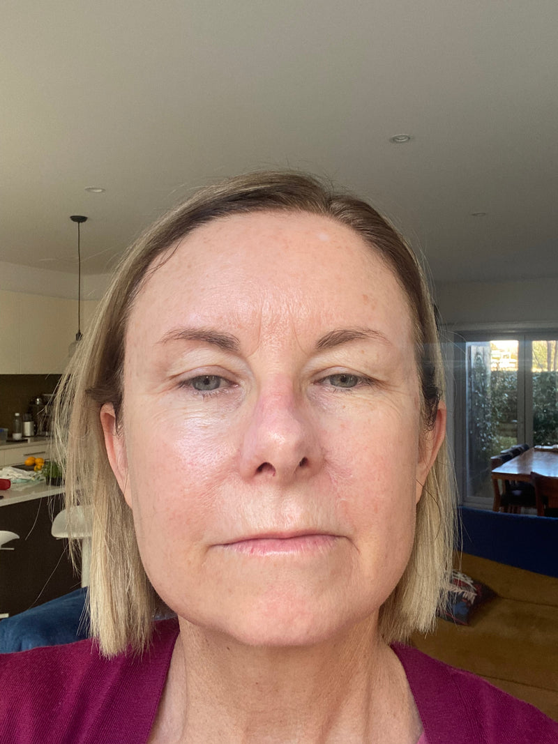After Rosacea