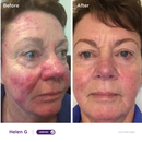 Starter Sensitive, Dry/Rosacea Kit